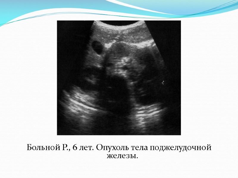 Больной Р., 6 лет. Опухоль тела поджелудочной железы.